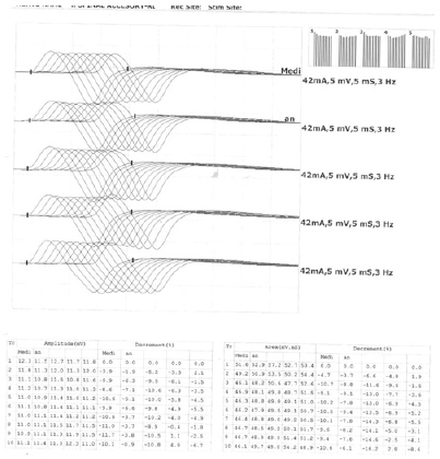 Repetitive nerve stimulation of median nerve at 3 Hz showing significant decrementing responses in Compound Muscle Action Potential (>10%) suggestive of post-synaptic neuromuscular transmission disorder-Myasthenia Gravis.